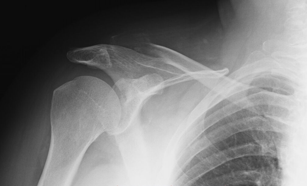 shoulder arthrosis x-ray
