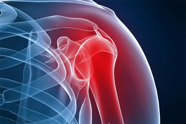 shoulder pain due to osteoarthritis