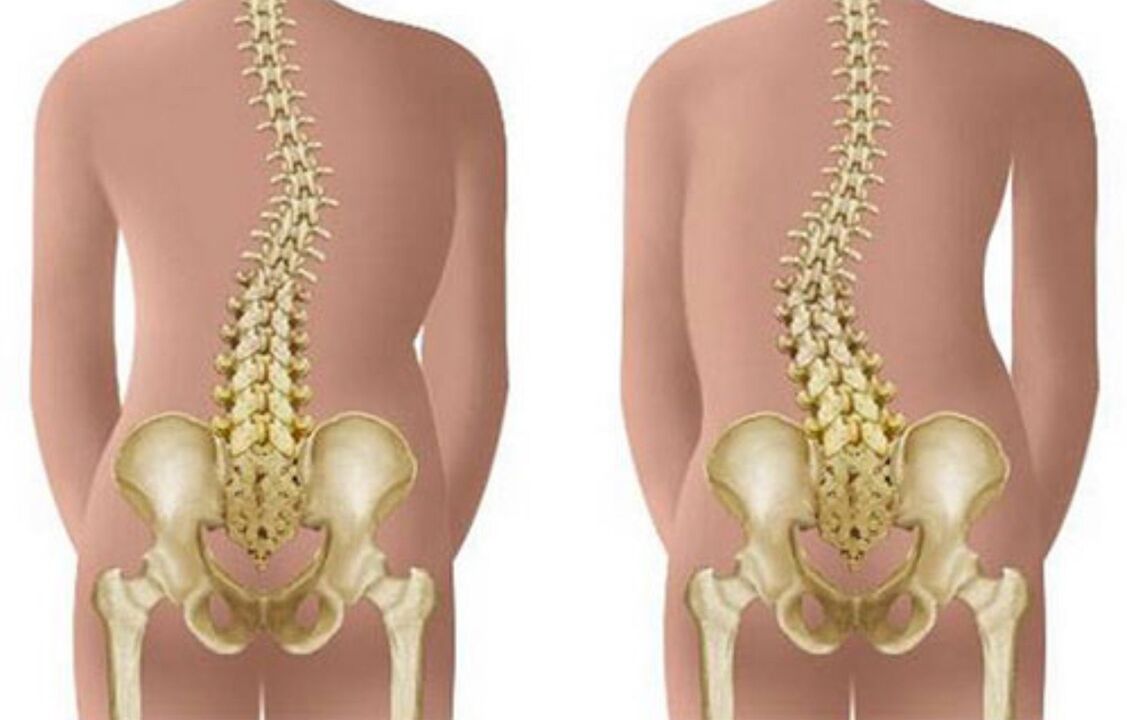 scoliosis as a cause of back pain in the area of ​​the shoulder blades