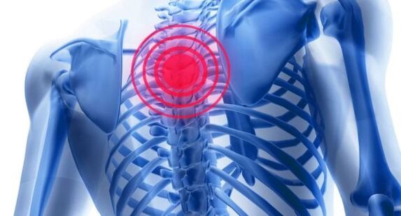 Treatment of osteochondrosis of the thoracic spine