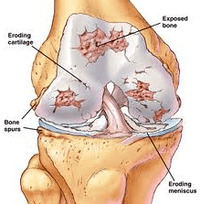 The mechanism of development of arthrosis